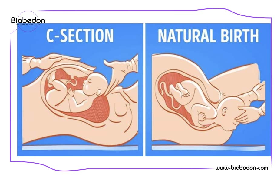 تفاوت زایمان طبیعی و سزارین